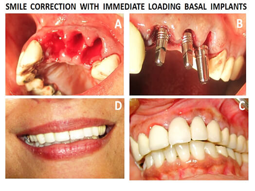ami-dental-house-dental-implant-procedures