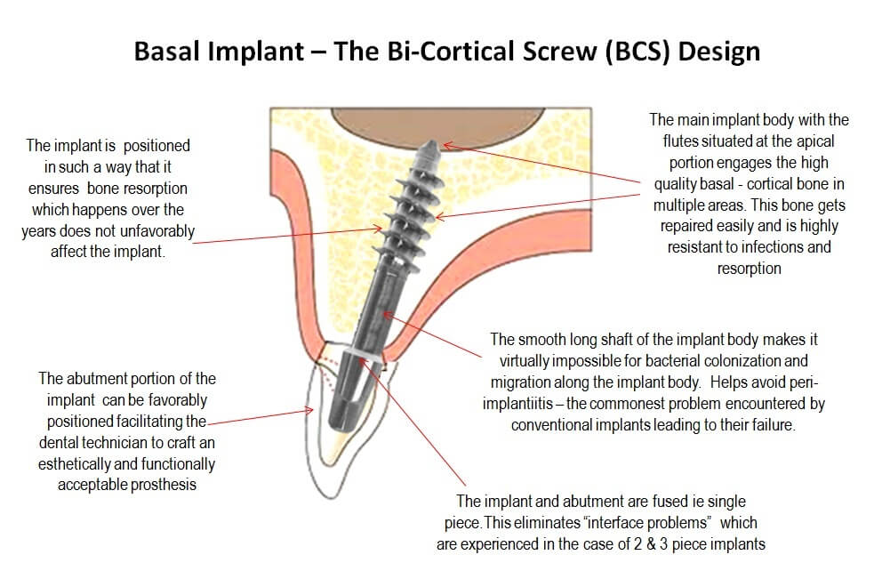 ami-dental-house-basal-implantology