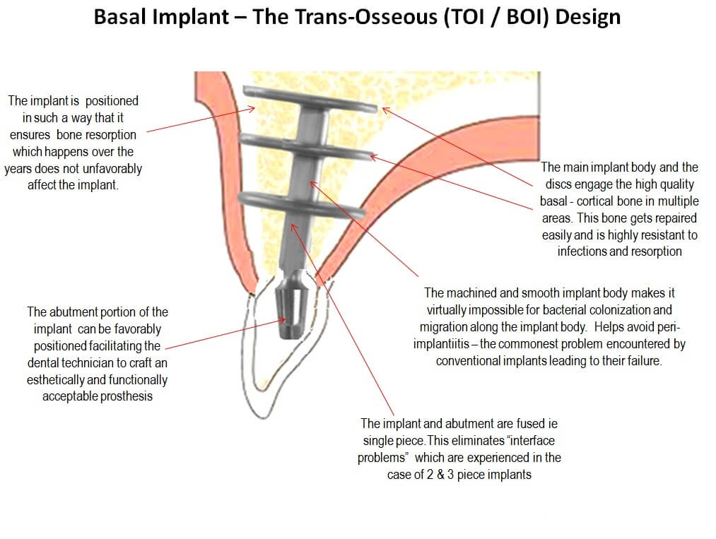 ami-dental-house-basal-implantology