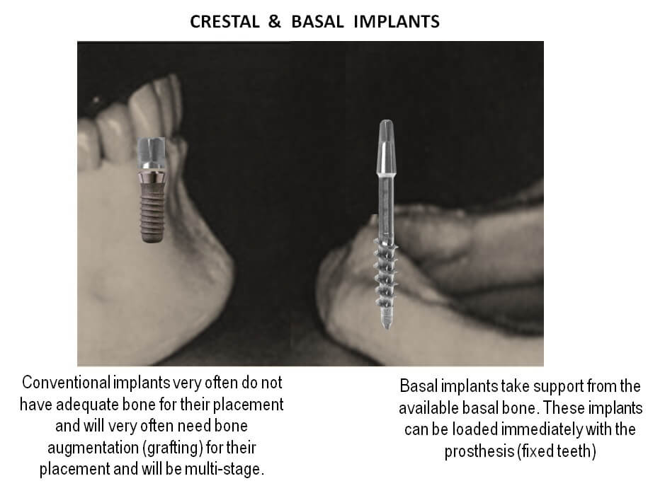 ami-dental-house-basal-implantology