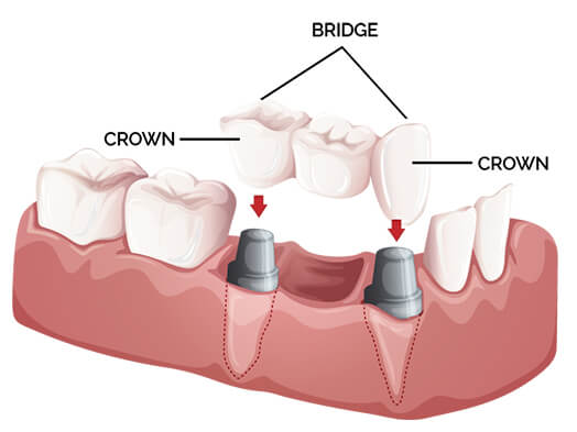 ami-dental-house-dental-crown-and-bridges