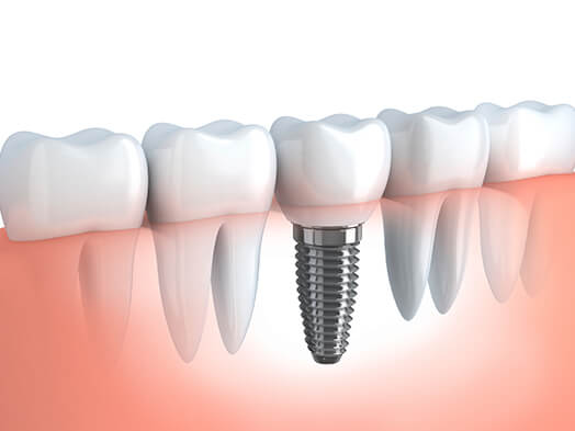 ami-dental-house-dental-implants-in-thaltej