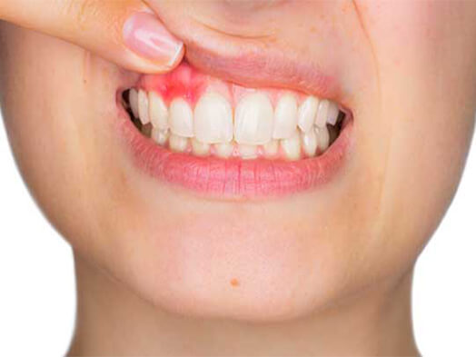 ami-dental-house-gum-diseases