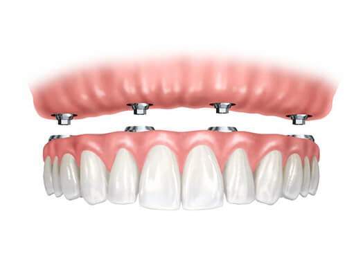 ami-dental-house-implant-overview