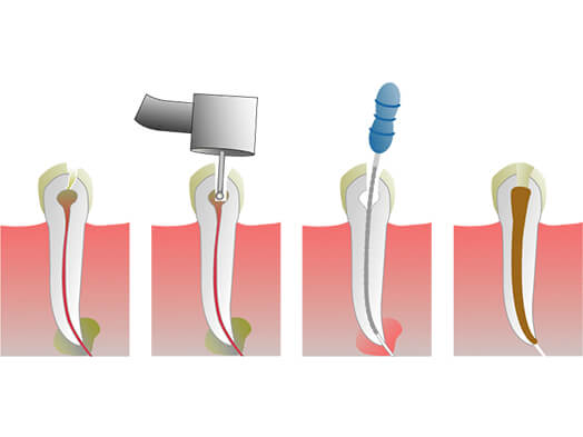 ami-dental-house-root-canal