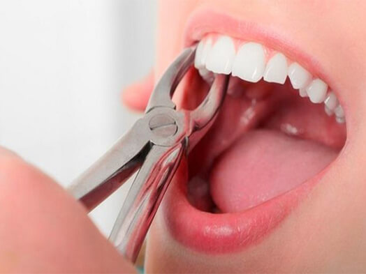 ami-dental-house-tooth-removal