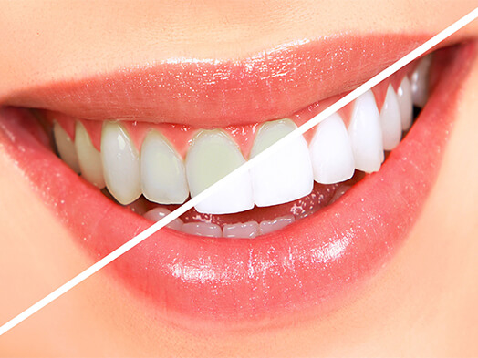 ami-dental-house-teeth-whitening